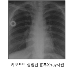 케모포트 삽입된 흉부X-ray사진