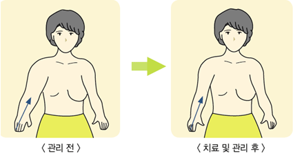 관리전 - 치료및 관리 후