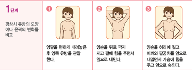 1단계 - 평상시 유방의 모양이나 윤곽의 변화를 비교
1. 양팔을 편하게 내려놓은 후 양쪽 유방을 관찰한다.
2. 양손을 뒤로 깍지 끼고 팔에 힘을 주면서 옆으로 내민다.
3. 양손을 허리에 짚고 어깨와 팔꿈치를 앞으로 내밀면서 가슴에 힘을 주고 앞으로 숙인다.
