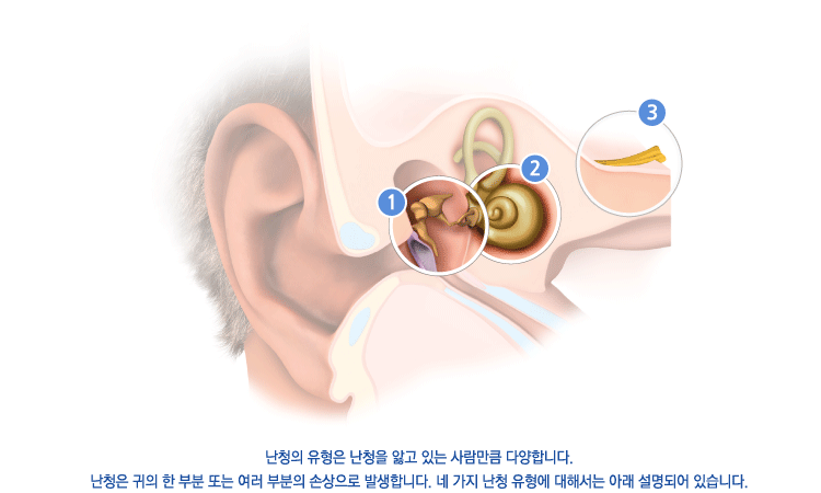 난청의 유형은 난청을 앓고 있는 사람만큼 다양합니다.난청은 귀의 한 부분 또는 여러 부분의 손상으로 발생합니다. 네 가지 난청 유형에 대해서는 아래 설명되어 있습니다.
